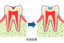 虫歯治療