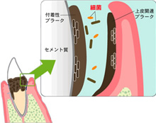 歯周病の原因は”細菌”です